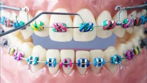 خرید جدیدترین انواع سیم ارتودنسی از معتبرترین برندهای دنیا