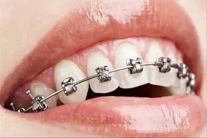 معرفی سیم ارتودنسی پروتکت + بهترین قیمت خرید