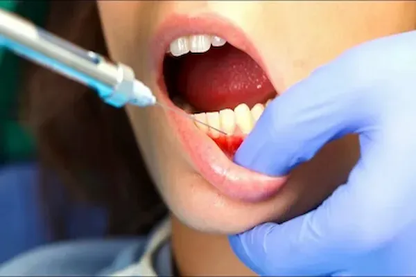 قیمت ژل بی حسی + خرید و فروش انکر عمده