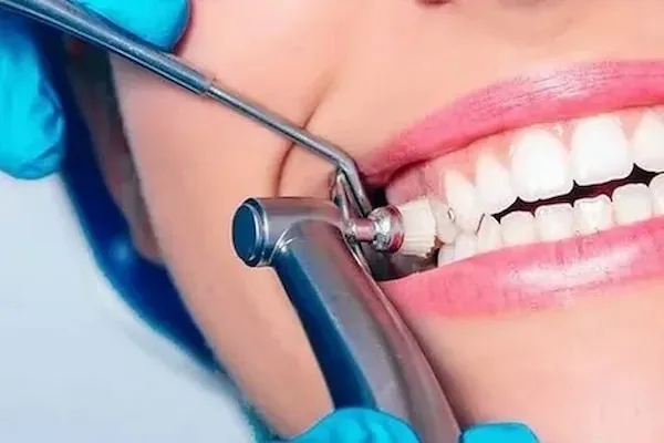 معرفی انواع پروفیلاکسی دندان + قیمت خرید روز